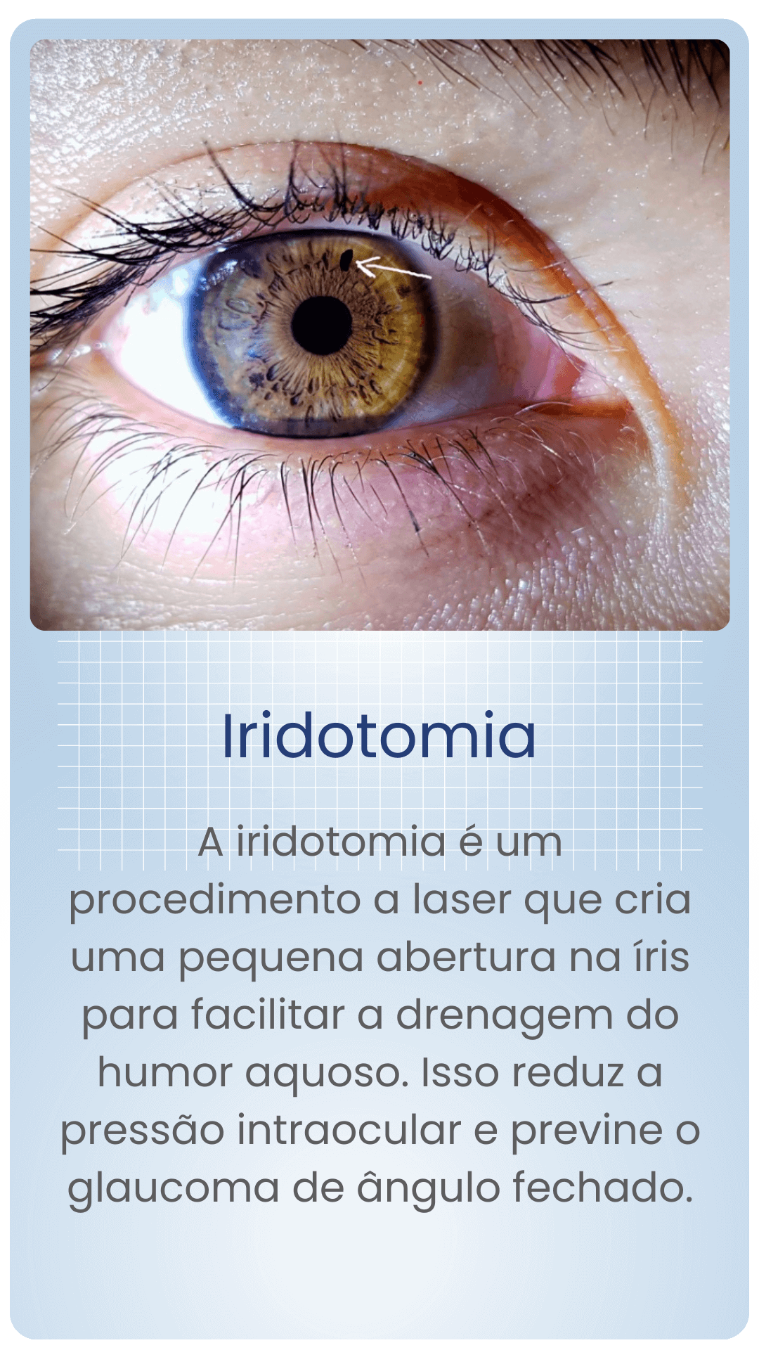 Iridotomia Ofltalmologista em Vila Velha