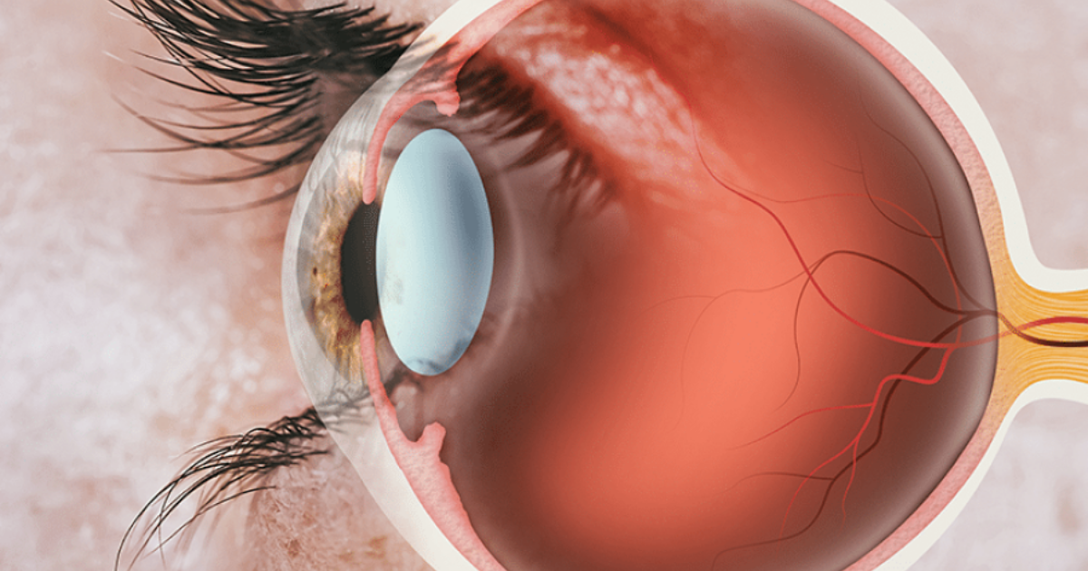 Retina: Guia Completo com, Doenças, Sintomas, Exames e Cirurgias