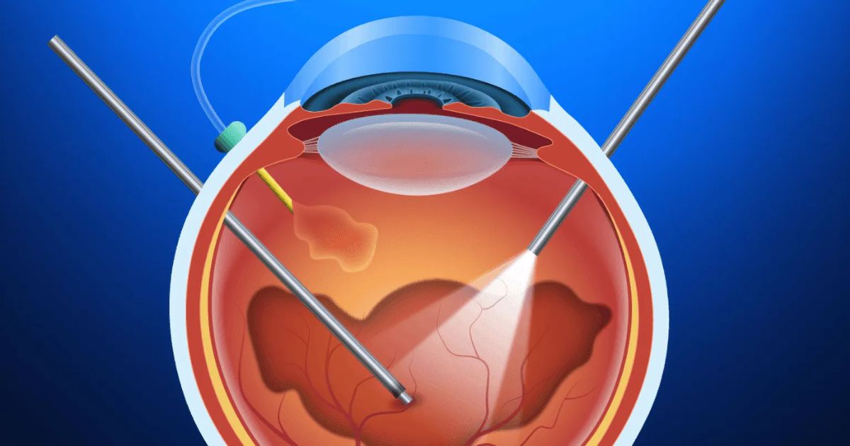 Cirurgia de Retina: quais são os tipos, indicações e como funcionam os tratamentos