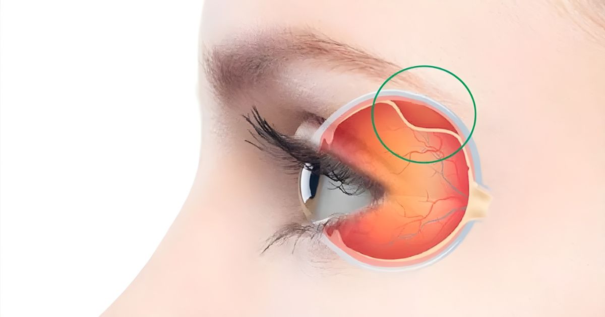 Descolamento de Retina: descubra os sinais de alerta e cirurgia para tratar