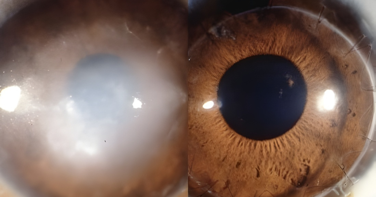 7 doenças da retina que podem causar cegueira