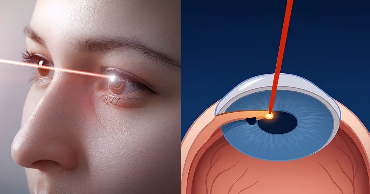 Iridotomia a Laser: o procedimento que previne a crise aguda de glaucoma
